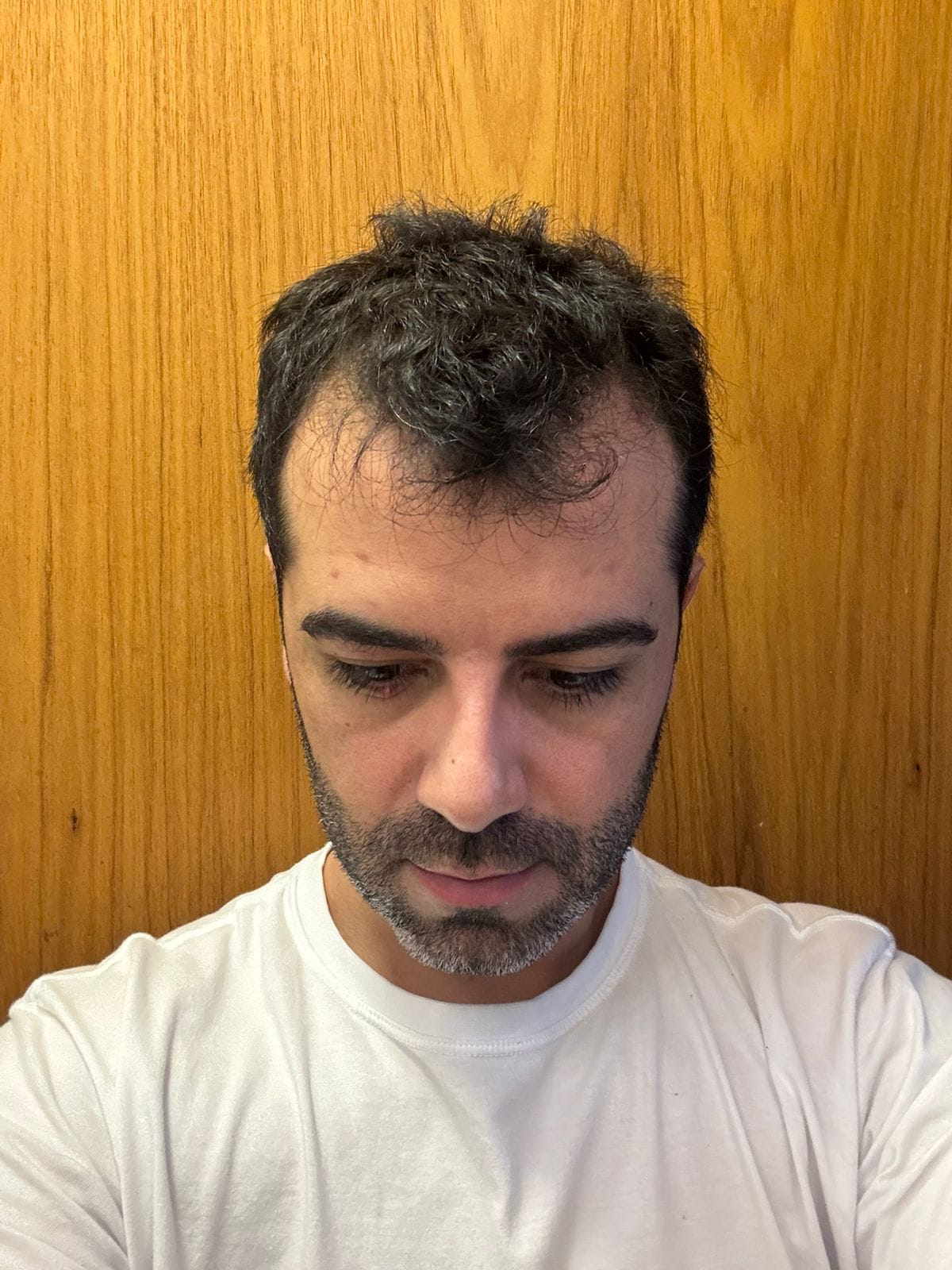 Antes — transplante capilar