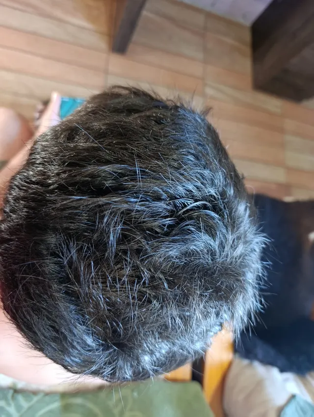 Depois de 4 meses, paciente Alberto