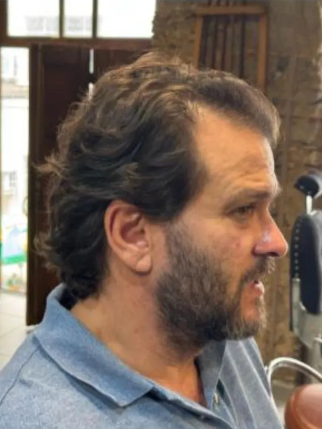 Antes do transplante capilar, paciente Alexandre