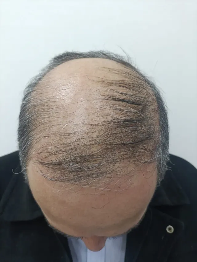 Depois de 3 meses, paciente Alisson