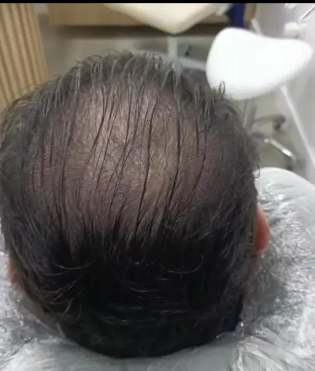 Depois de 2 meses, paciente Cristiano