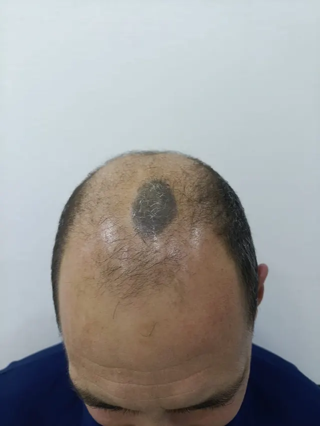 Depois de 4 meses, paciente Silvano