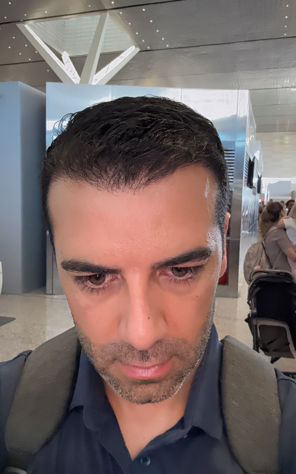 Depois — transplante capilar